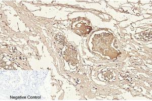 Immunohistochemical analysis of paraffin-embedded human breast tissue. (Caspase 3 p12 (AA 130-210), (Cleaved-Asp175) Antikörper)