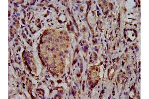 IHC image of ABIN7169920 diluted at 1:500 and staining in paraffin-embedded human pancreatic cancer performed on a Leica BondTM system. (SCN11A Antikörper  (AA 403-551))