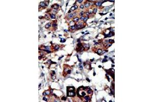 Formalin-fixed and paraffin-embedded human cancer tissue reacted with PACSIN3 polyclonal antibody  , which was peroxidase-conjugated to the secondary antibody, followed by AEC staining. (PACSIN3 Antikörper  (N-Term))