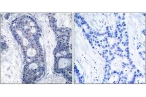 Immunohistochemistry analysis of paraffin-embedded human breast carcinoma tissue, using eIF4E (Ab-209) Antibody. (EIF4E Antikörper  (AA 168-217))