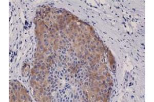 Immunohistochemical staining (Formalin-fixed paraffin-embedded sections) of human breast cancer with ACACA/ACACB (phospho S79) monoclonal antibody, clone RM270 . (Acetyl-CoA Carboxylase alpha Antikörper  (pSer79))