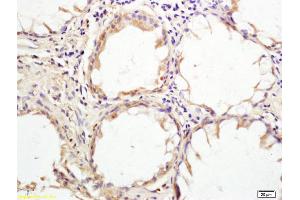 Formalin-fixed and paraffin embedded human rectal carcinoma tissue labeled with Anti HHLA2 Polyclonal Antibody, Unconjugated (ABIN1388019) at 1:200 followed by conjugation to the secondary antibody and DAB staining (HHLA2 Antikörper  (AA 231-330))