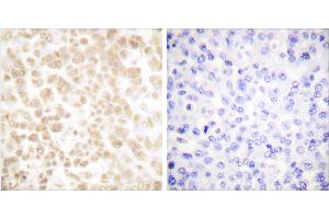 Peptide - +Immunohistochemical analysis of paraffin-embedded human breast carcinoma tissue using Fra-2 antibody (#C0197). (FOSL2 Antikörper)