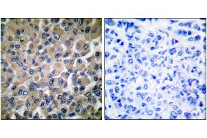 Immunohistochemical analysis of paraffin-embedded human breast carcinoma tissue using GRP78 antibody. (GRP78 Antikörper)