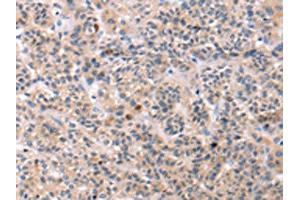The image on the left is immunohistochemistry of paraffin-embedded Human liver cancer tissue using ABIN7192749(TCERG1L Antibody) at dilution 1/30, on the right is treated with synthetic peptide. (TCERG1L Antikörper)