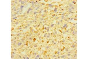 Immunohistochemistry of paraffin-embedded human melanoma using ABIN7176008 at dilution of 1:100 (ZSCAN29 Antikörper  (AA 1-300))