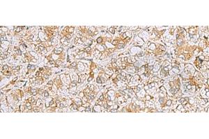 Immunohistochemistry of paraffin-embedded Human liver cancer tissue using FERMT1 Polyclonal Antibody at dilution of 1:30(x200) (FERMT1 Antikörper)