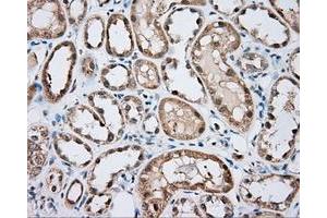 Immunohistochemical staining of paraffin-embedded Carcinoma of liver tissue using anti-BTK mouse monoclonal antibody. (BTK Antikörper)