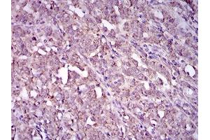 Immunohistochemical analysis of paraffin-embedded cervical cancer tissues using ITGA2B mouse mAb with DAB staining. (Integrin Alpha2b Antikörper  (AA 45-149))