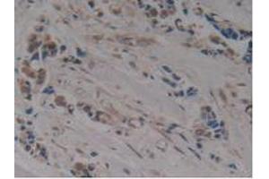 IHC-P analysis of Human Breast Cancer Tissue, with DAB staining. (MAPT Antikörper  (AA 130-386))