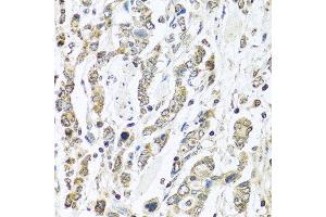 Immunohistochemistry of paraffin-embedded human gastric cancer using IFNL3 antibody at dilution of 1:100 (40x lens). (IL28B Antikörper)
