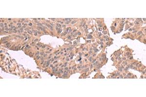 Immunohistochemistry of paraffin-embedded Human colorectal cancer tissue using MAGEC2 Polyclonal Antibody at dilution of 1:60(x200) (MAGEC2 Antikörper)