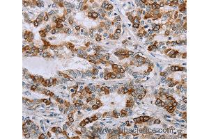 Immunohistochemistry of Human cervical cancer using NMT1 Polyclonal Antibody at dilution of 1:45 (NMT1 Antikörper)