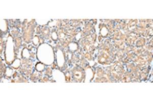 Immunohistochemistry of paraffin-embedded Human thyroid cancer tissue using DPH7 Polyclonal Antibody at dilution of 1:40(x200)