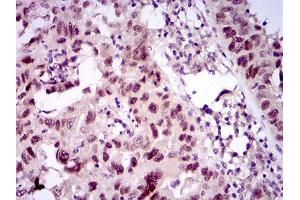 Immunohistochemical analysis of paraffin-embedded endometrial cancer tissues using TP53BP1 mouse mAb with DAB staining. (TP53BP1 Antikörper  (AA 574-773))
