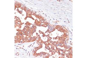 Immunohistochemistry of paraffin-embedded Human mammary cancer using PGD antibody (ABIN6127314, ABIN6145502, ABIN6145503 and ABIN6223639) at dilution of 1:100 (40x lens). (PGD Antikörper  (AA 184-483))