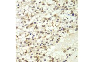 Immunohistochemistry of paraffin-embedded human kidney cancer using LHX4 antibody (ABIN5975324) at dilution of 1/100 (40x lens). (LHX4 Antikörper)