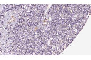 ABIN6273176 at 1/100 staining Human lymph cancer tissue by IHC-P. (TIMM44 Antikörper  (N-Term))