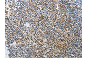 The image on the left is immunohistochemistry of paraffin-embedded Human tonsil tissue using ABIN7189642(AD7C-NTP Antibody) at dilution 1/25, on the right is treated with synthetic peptide. (AD7C-NTP Antikörper)