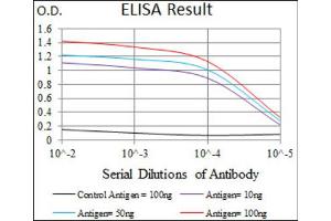Immunohistochemical analysis of paraffin-embedded rectum cancer tissues using T antibody with DAB staining. (T Antigen (AA 257-309) Antikörper)