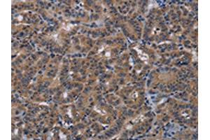 The image on the left is immunohistochemistry of paraffin-embedded Human thyroid cancer tissue using ABIN7191819(PDE4A Antibody) at dilution 1/40, on the right is treated with synthetic peptide. (PDE4A Antikörper)