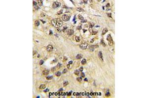 Formalin-fixed and paraffin-embedded human prostate carcinoma tissue reacted with MYC polyclonal antibody  , which was peroxidase-conjugated to the secondary antibody, followed by DAB staining. (c-MYC Antikörper  (Thr58))