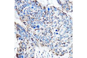 Immunohistochemistry of paraffin-embedded human esophageal cancer using OAT Rabbit pAb (ABIN6127442, ABIN6144985, ABIN6144986 and ABIN6221831) at dilution of 1:150 (40x lens). (OAT Antikörper  (AA 160-439))