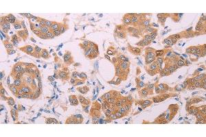 Immunohistochemistry of paraffin-embedded Human breast cancer using AGT Polyclonal Antibody at dilution of 1:30 (AGT Antikörper)