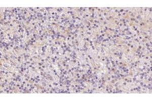 ABIN6273084 at 1/100 staining Human lymph cancer tissue by IHC-P. (UQCRFS1 Antikörper  (C-Term))