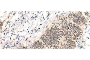 Immunohistochemistry of paraffin-embedded Human colorectal cancer tissue using AURKA Polyclonal Antibody at dilution of 1:40(x200) (Aurora A Antikörper)