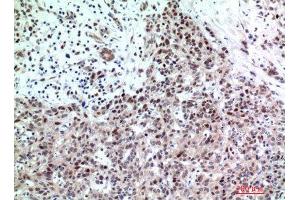 Immunohistochemistry (IHC) analysis of paraffin-embedded Human Breast Cancer, antibody was diluted at 1:200.