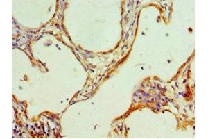 Immunohistochemistry of paraffin-embedded human cervical cancer using ABIN7155200 at dilution of 1:100 (HMGN4 Antikörper  (AA 1-90))