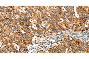 Immunohistochemistry of paraffin-embedded Human ovarian cancer using SSTR1 Polyclonal Antibody at dilution of 1:40 (SSTR1 Antikörper)