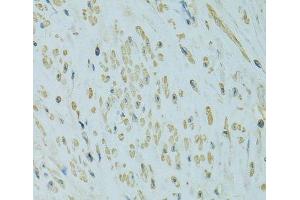 Immunohistochemistry of paraffin-embedded Human uterine cancer using UGT1A6 Polyclonal Antibody at dilution of 1:100 (40x lens). (UGT1A6 Antikörper)