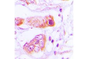Immunohistochemical analysis of BAIAP2L2 staining in human lung cancer formalin fixed paraffin embedded tissue section.