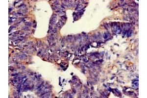 Immunohistochemistry of paraffin-embedded human colon cancer using ABIN7172340 at dilution of 1:100 (TNIK Antikörper  (AA 523-714))