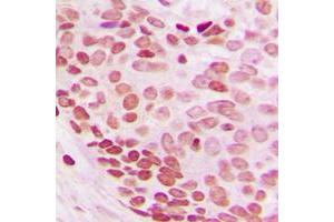 Immunohistochemical analysis of NEDD8 staining in human breast cancer formalin fixed paraffin embedded tissue section. (NEDD8 Antikörper  (N-Term))