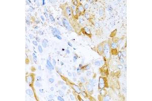 Immunohistochemistry of paraffin-embedded mouse esophageal cancer using SPINT1 antibody (ABIN5973812) at dilution of 1/100 (40x lens). (SPINT1 Antikörper)