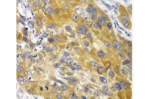 Immunohistochemistry of paraffin-embedded Human esophageal cancer using AK1 Polyclonal Antibody at dilution of 1:100 (40x lens). (Adenylate Kinase 1 Antikörper)