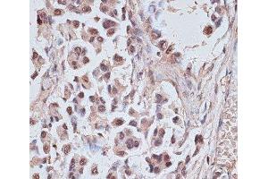 Immunohistochemistry of paraffin-embedded Human lung cancer using NR5A2 Polyclonal Antibody at dilution of 1:100 (40x lens). (NR5A2 + LRH1 Antikörper)