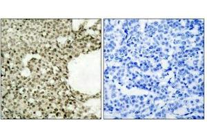 Immunohistochemical analysis of paraffin-embedded human breast carcinoma tissue using STAT1(Phospho-Ser727) Antibody(left) or the same antibody preincubated with blocking peptide(right). (STAT1 Antikörper  (pSer727))