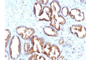 Formalin-fixed, paraffin-embedded human Prostate Carcinoma stained with PSAP Monoclonal Antibody (PASE/4LJ). (ACPP Antikörper)