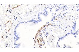 Detection of CALPRO in Human Lung Tissue using Polyclonal Antibody to Calprotectin (CALPRO) (S100A8/A9 Complex (Calprotectin) Antikörper  (AA 1-114))
