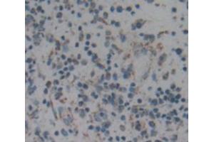 IHC-P analysis of liver cancer tissue, with DAB staining. (ARPC2 Antikörper  (AA 1-300))