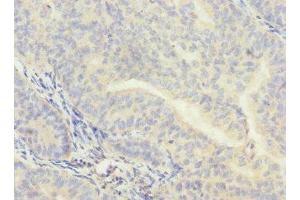 Immunohistochemistry of paraffin-embedded human endometrial cancer using ABIN7147920 at dilution of 1:100 (CPSF4 Antikörper  (AA 1-244))
