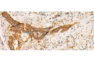 Immunohistochemistry of paraffin-embedded Human esophagus cancer tissue using SMUG1 Polyclonal Antibody at dilution of 1:50(x200) (SMUG1 Antikörper)