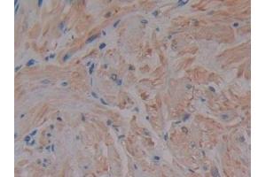 DAB staining on IHC-P; Samples: Human Prostate Tissue (MMP2 Antikörper  (AA 110-660))