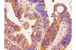 Immunohistochemistry of paraffin-embedded human colon cancer using ABIN7170044 at dilution of 1:100