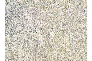 PPP1R7 Mouse Monoclonal Antibody at 1/100 staining human gastric cancer by IHC-P. (PPP1R7 Antikörper  (C-Term))