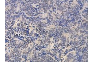 ABIN6260723 and ABIN6276724 at 1/100 staining human small cell lung carcinoma by IHC-P. (CDK9 Antikörper  (Internal Region))